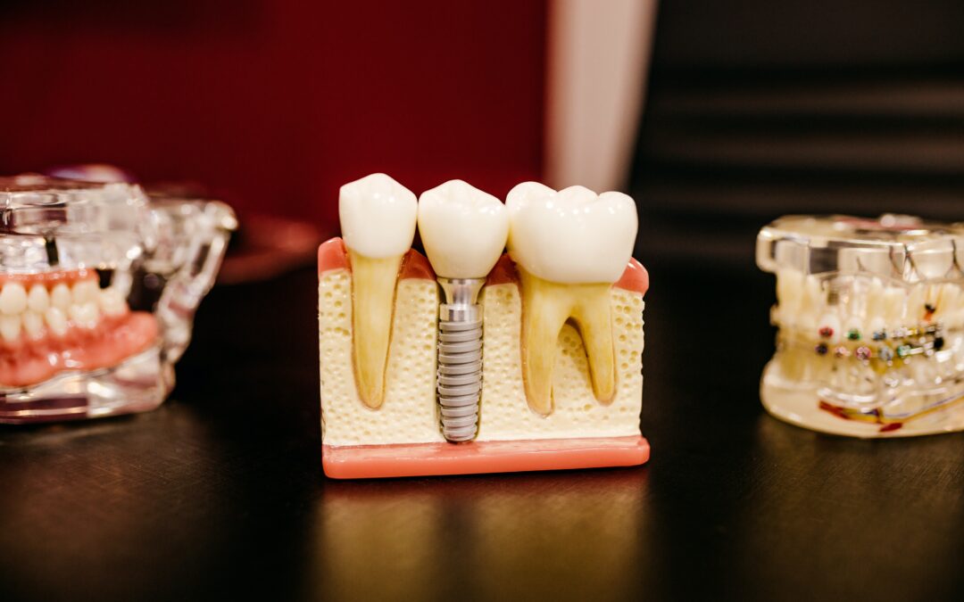 Mentally Preparing for Dental Implant Surgery