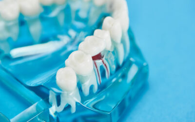 Bone Grafting for Dental Implants: When It’s Needed and Why