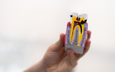 Cracked Tooth: Symptoms and Treatment Options