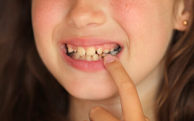 Tooth Decay in Children: Early Signs and How to Prevent It
